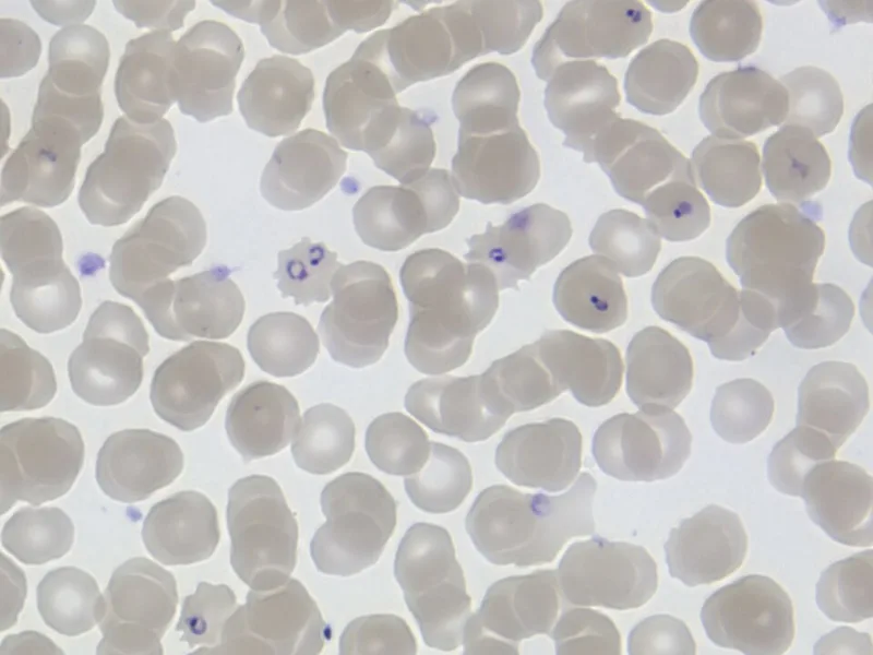 Malaria parasite seen in a stained blood smear under the microscope